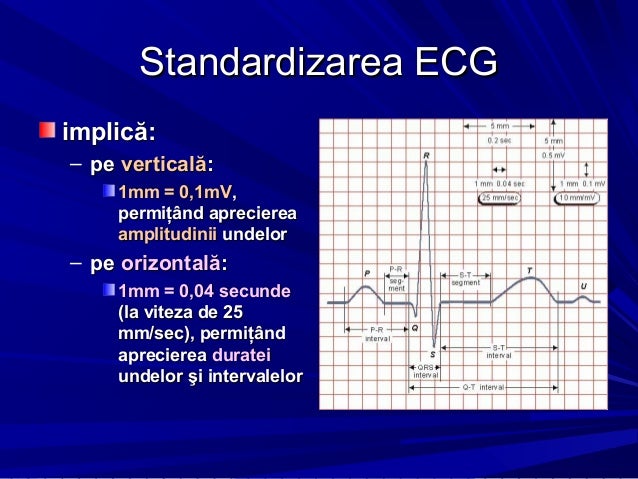 interpretare ecg